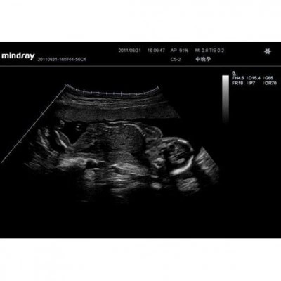 УЗИ-аппарат Mindray DC-T6 УЗИ-аппарат Mindray DC-T6