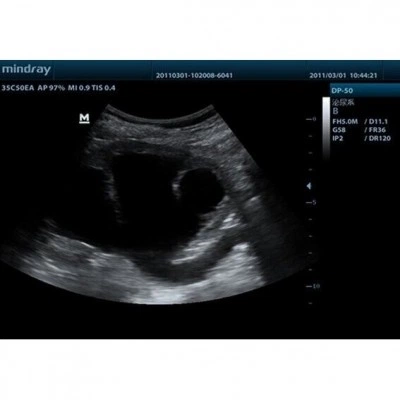 Портативный УЗИ-аппарат Mindray DP-50 Портативный УЗИ-аппарат Mindray DP-50