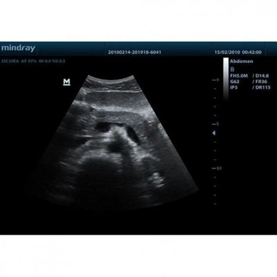 Портативный УЗИ-аппарат Mindray DP-50 Портативный УЗИ-аппарат Mindray DP-50